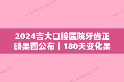 2024吉大口腔医院牙齿正畸果图公布｜180天变化果图一览