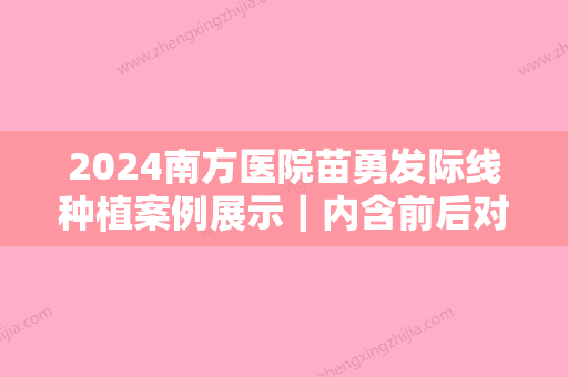 2024南方医院苗勇发际线种植案例展示｜内含前后对比图