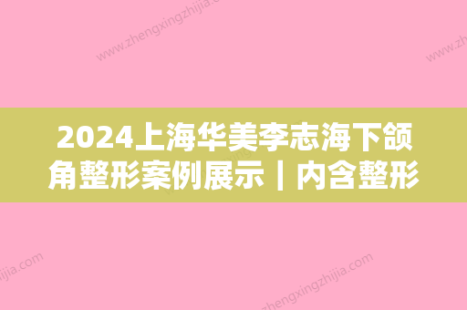 2024上海华美李志海下颌角整形案例展示｜内含整形全细节