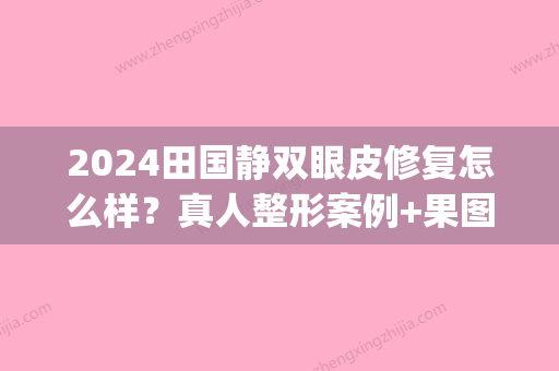 2024田国静双眼皮修复怎么样？真人整形案例+果图分享(田国静双眼皮修复费用)