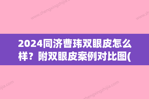 2024同济曹玮双眼皮怎么样？附双眼皮案例对比图(同济双眼皮医生)