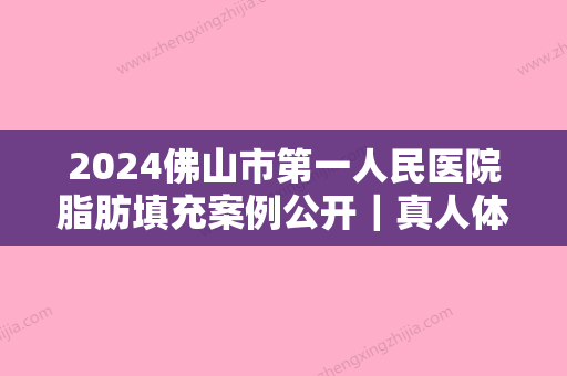 2024佛山市第一人民医院脂肪填充案例公开｜真人体验果图分享