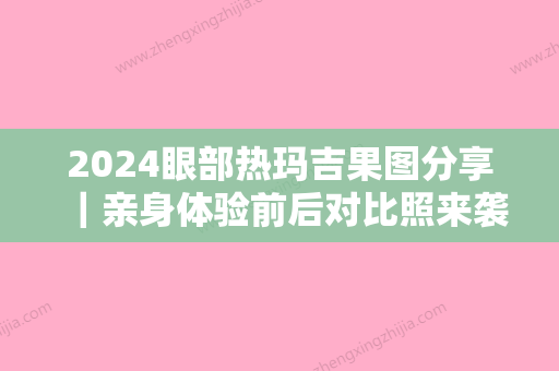 2024眼部热玛吉果图分享｜亲身体验前后对比照来袭