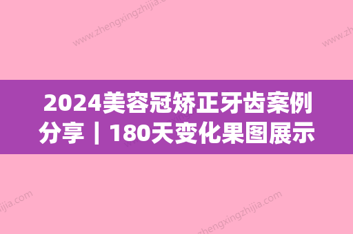 2024美容冠矫正牙齿案例分享｜180天变化果图展示(美容冠 矫正牙齿)