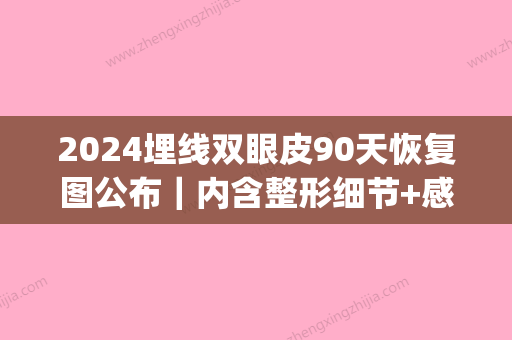 2024埋线双眼皮90天恢复图公布｜内含整形细节+感悟(埋线双眼皮三天恢复图)