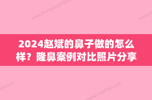 2024赵斌的鼻子做的怎么样？隆鼻案例对比照片分享(韩兴斌隆鼻)