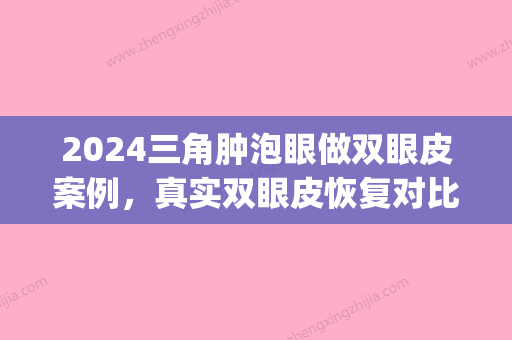 2024三角肿泡眼做双眼皮案例，真实双眼皮恢复对比图(肿眼泡双眼皮对比照)