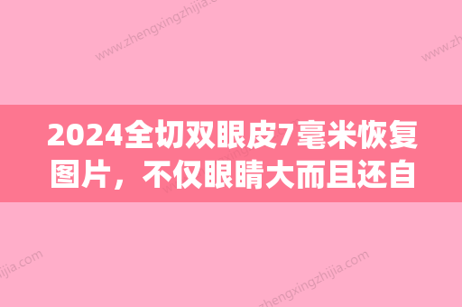 2024全切双眼皮7毫米恢复图片，不仅眼睛大而且还自然~(全切双眼皮一到七天恢复图)