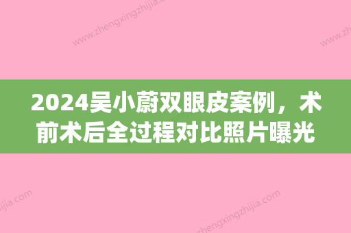 2024吴小蔚双眼皮案例，术前术后全过程对比照片曝光！(武汉吴小蔚做双眼皮)