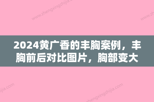 2024黄广香的丰胸案例，丰胸前后对比图片，胸部变大的秘诀