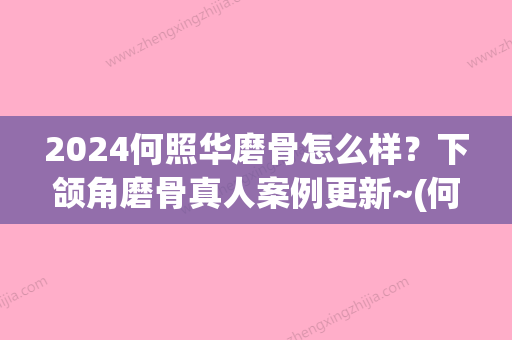 2024何照华磨骨怎么样？下颌角磨骨真人案例更新~(何照华磨骨技术怎么样)