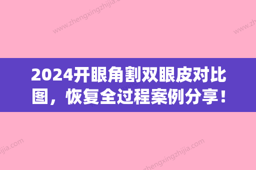 2024开眼角割双眼皮对比图，恢复全过程案例分享！(割双眼皮两周图片)