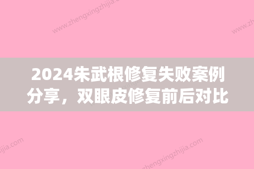 2024朱武根修复失败案例分享，双眼皮修复前后对比图片分享(朱晓峰双眼皮修复)