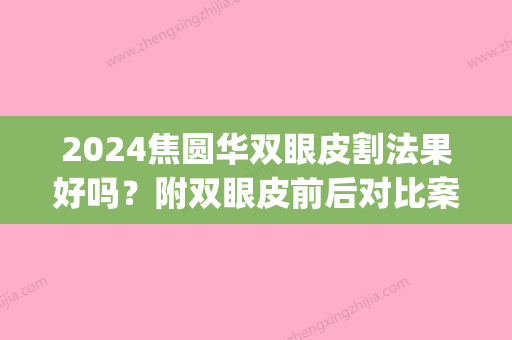 2024焦圆华双眼皮割法果好吗？附双眼皮前后对比案例分享(焦圆华做双眼皮怎么样)