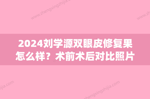 2024刘学源双眼皮修复果怎么样？术前术后对比照片分享(怎么联系刘学源修复双眼皮)