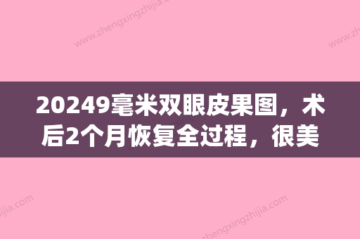 20249毫米双眼皮果图，术后2个月恢复全过程，很美！(一厘米双眼皮术后效果图)