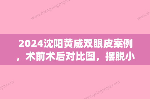 2024沈阳黄威双眼皮案例，术前术后对比图	，摆脱小眼睛的困扰！(沈阳医大黄威双眼皮)