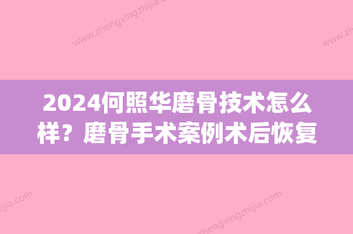 2024何照华磨骨技术怎么样？磨骨手术案例术后恢复对比图一览(何照华磨骨案例评价)