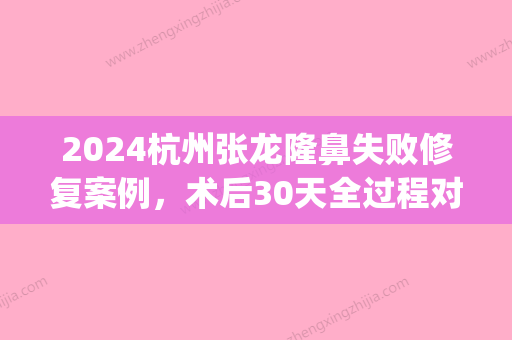 2024杭州张龙隆鼻失败修复案例，术后30天全过程对比图(隆鼻医生张龙)