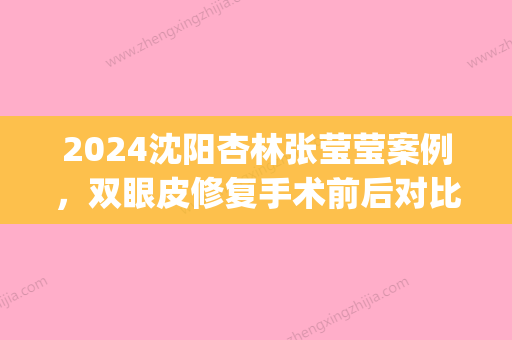 2024沈阳杏林张莹莹案例	，双眼皮修复手术前后对比照片分享(沈阳杏林双眼皮医生)