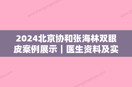 2024北京协和张海林双眼皮案例展示｜医生资料及实力集中一览