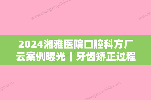 2024湘雅医院口腔科方厂云案例曝光｜牙齿矫正过程集中一览