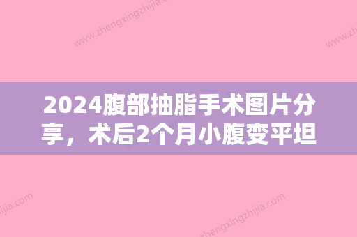 2024腹部抽脂手术图片分享	，术后2个月小腹变平坦！