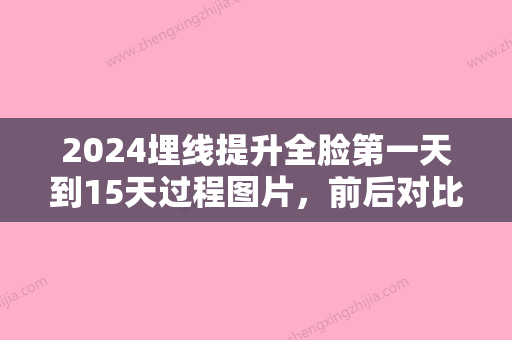 2024埋线提升全脸第一天到15天过程图片，前后对比果棒极了