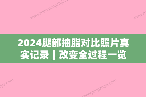 2024腿部抽脂对比照片真实记录｜改变全过程一览