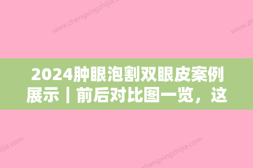 2024肿眼泡割双眼皮案例展示｜前后对比图一览，这是同一人？