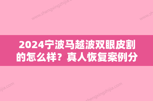 2024宁波马越波双眼皮割的怎么样？真人恢复案例分享