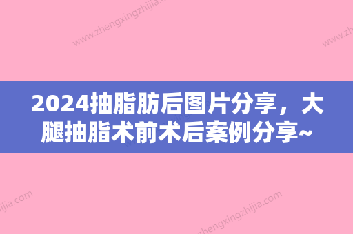 2024抽脂肪后图片分享，大腿抽脂术前术后案例分享~