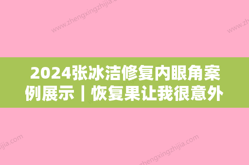 2024张冰洁修复内眼角案例展示｜恢复果让我很意外