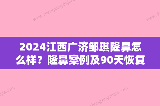 2024江西广济邹琪隆鼻怎么样？隆鼻案例及90天恢复果图展示