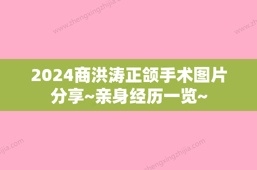 2024商洪涛正颌手术图片分享~亲身经历一览~