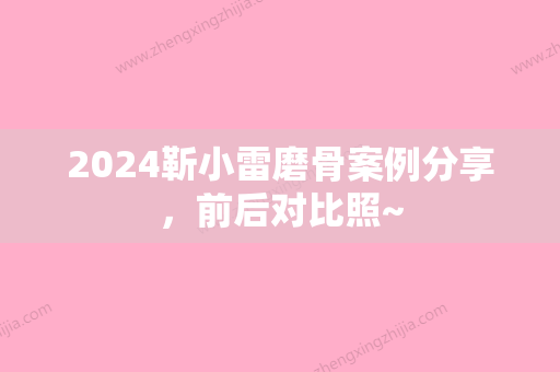 2024靳小雷磨骨案例分享，前后对比照~