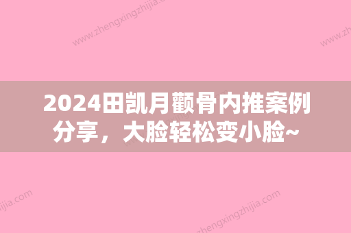 2024田凯月颧骨内推案例分享，大脸轻松变小脸~