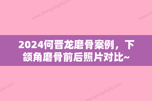 2024何晋龙磨骨案例，下颌角磨骨前后照片对比~