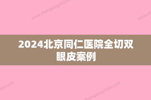 2024北京同仁医院全切双眼皮案例