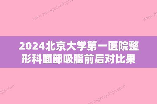 2024北京大学第一医院整形科面部吸脂前后对比果