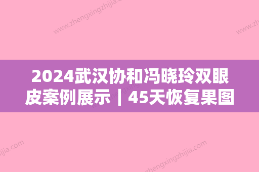 2024武汉协和冯晓玲双眼皮案例展示｜45天恢复果图一览