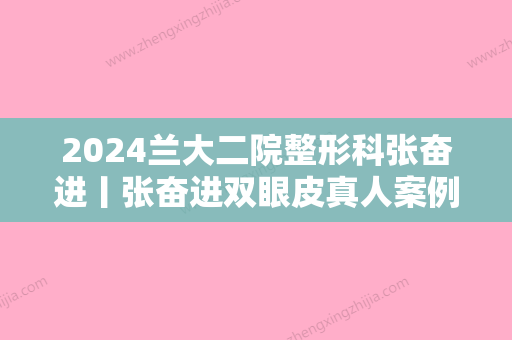 2024兰大二院整形科张奋进丨张奋进双眼皮真人案例分享~