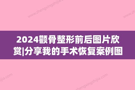 2024颧骨整形前后图片欣赏|分享我的手术恢复案例图(内附价格表)~