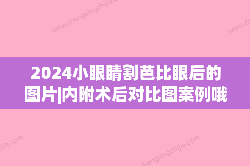 2024小眼睛割芭比眼后的图片|内附术后对比图案例哦~