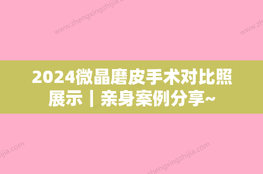 2024微晶磨皮手术对比照展示｜亲身案例分享~