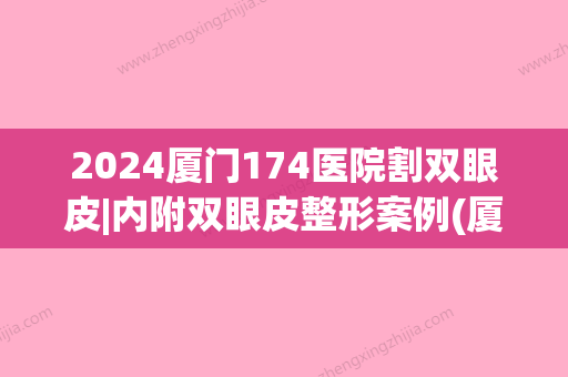 2024厦门174医院割双眼皮|内附双眼皮整形案例(厦门割双眼皮多少钱)