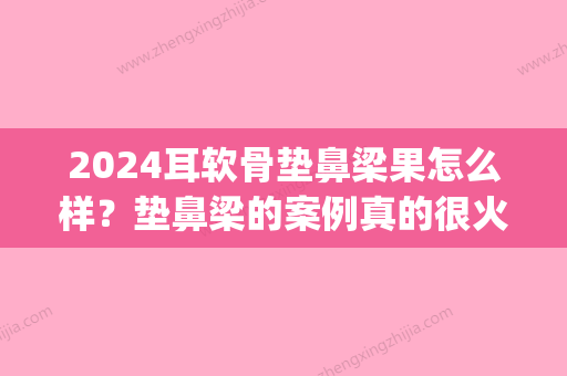 2024耳软骨垫鼻梁果怎么样？垫鼻梁的案例真的很火爆~(耳软骨垫鼻梁是永久的吗)