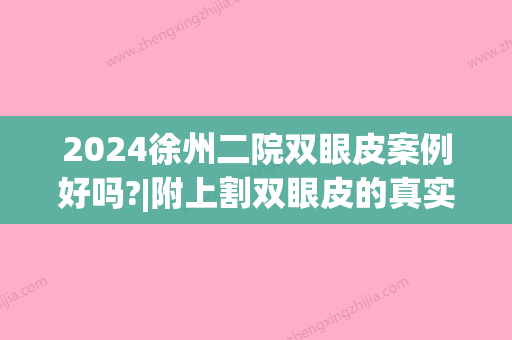 2024徐州二院双眼皮案例好吗?|附上割双眼皮的真实案例~(徐州二院可以割双眼皮吗)