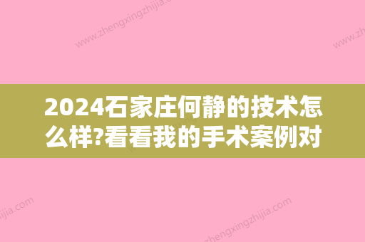 2024石家庄何静的技术怎么样?看看我的手术案例对比图就知道啦~