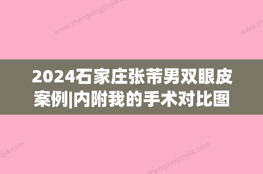 2024石家庄张芾男双眼皮案例|内附我的手术对比图